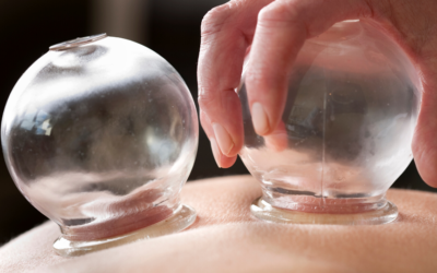What is cupping and why do so many people recommend cupping?